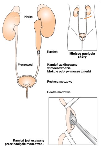 usuniecie kamienia z przewodu moczowego